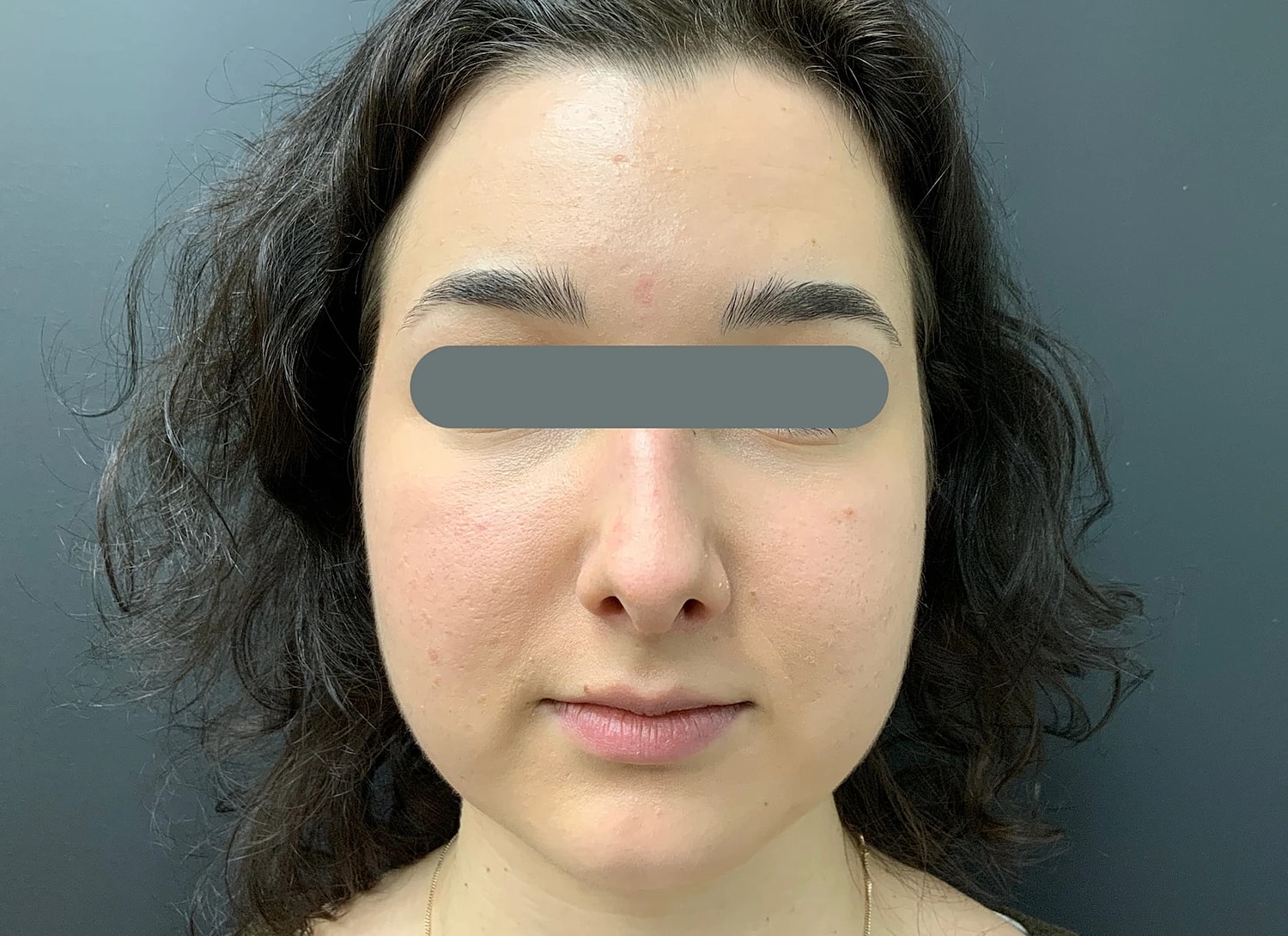 Rhinoplasty Before & After