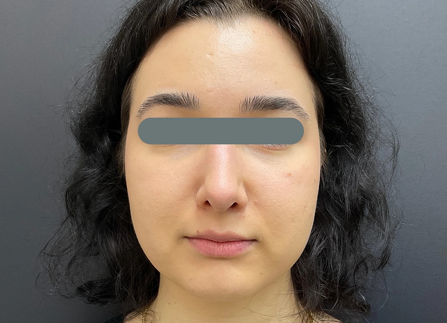 Rhinoplasty Before & After