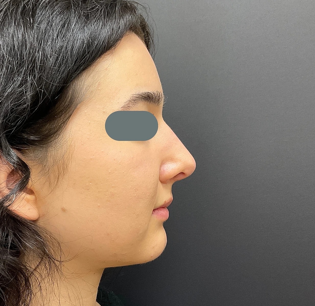 Rhinoplasty Before & After