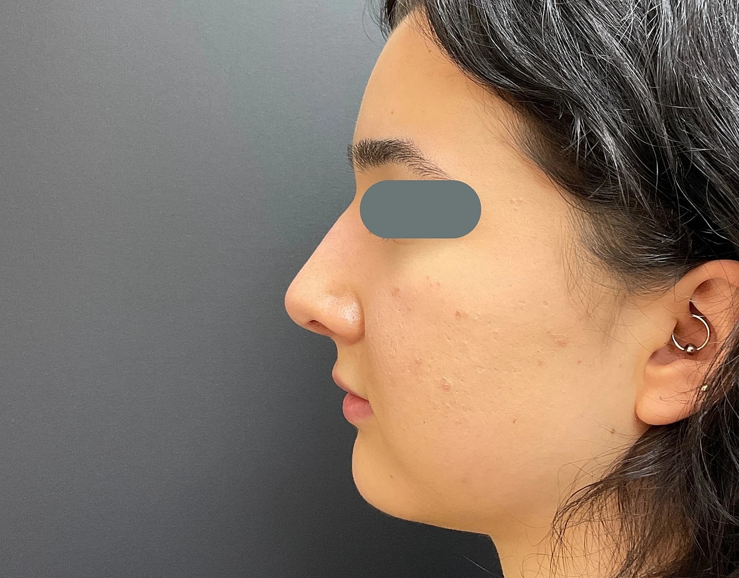 Rhinoplasty Before & After