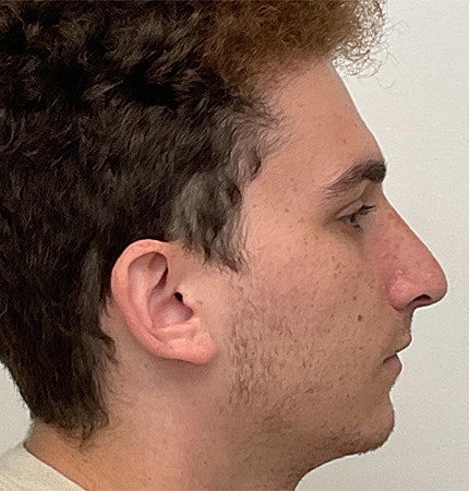 Rhinoplasty Before & After