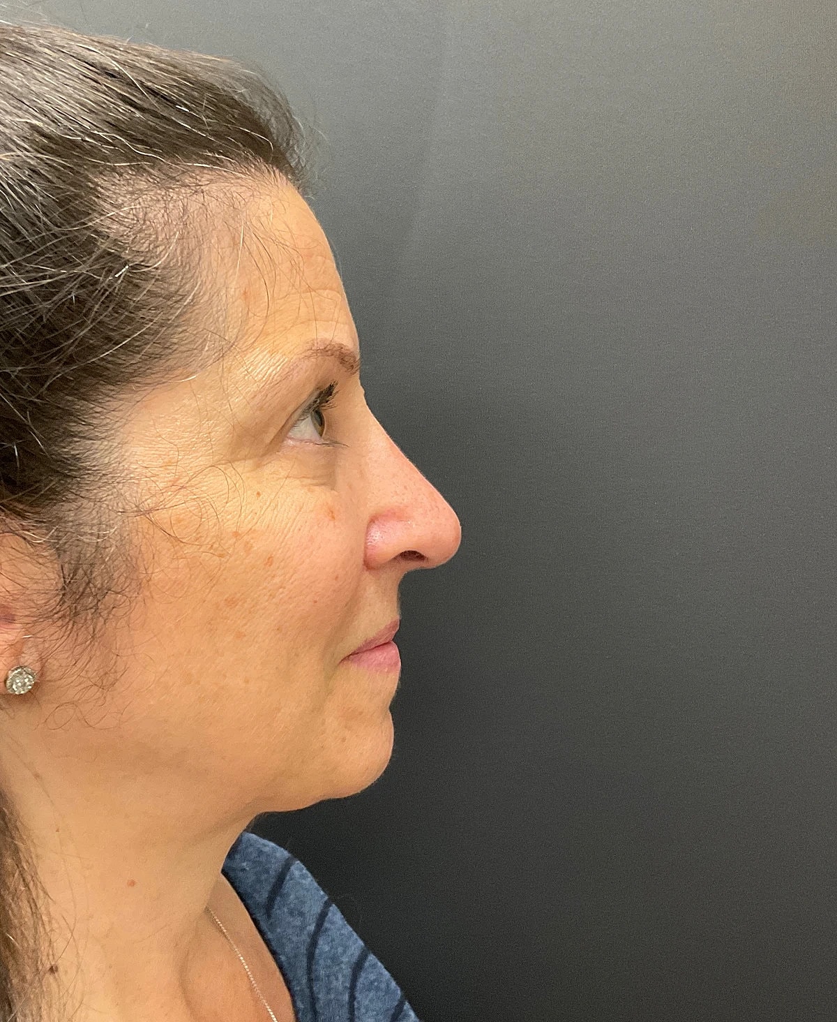 Rhinoplasty Before & After