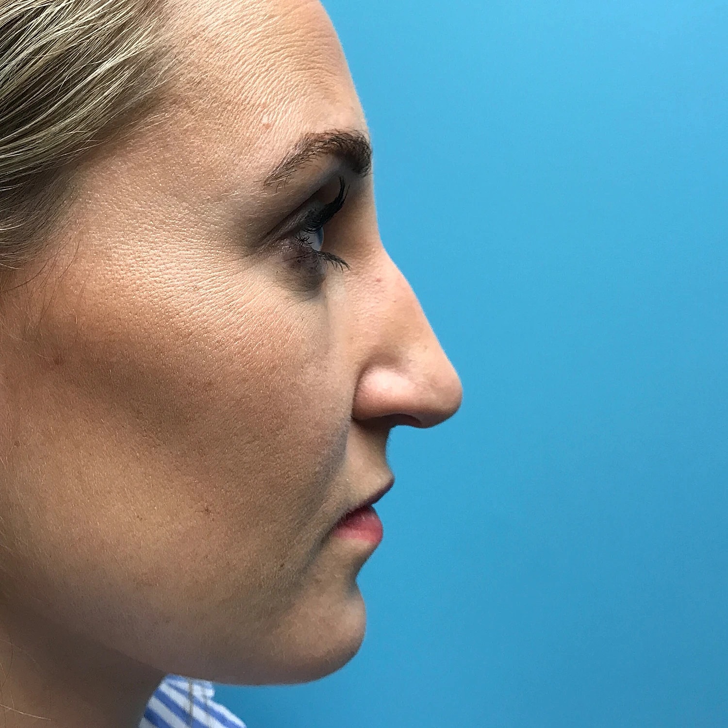 Rhinoplasty Before & After
