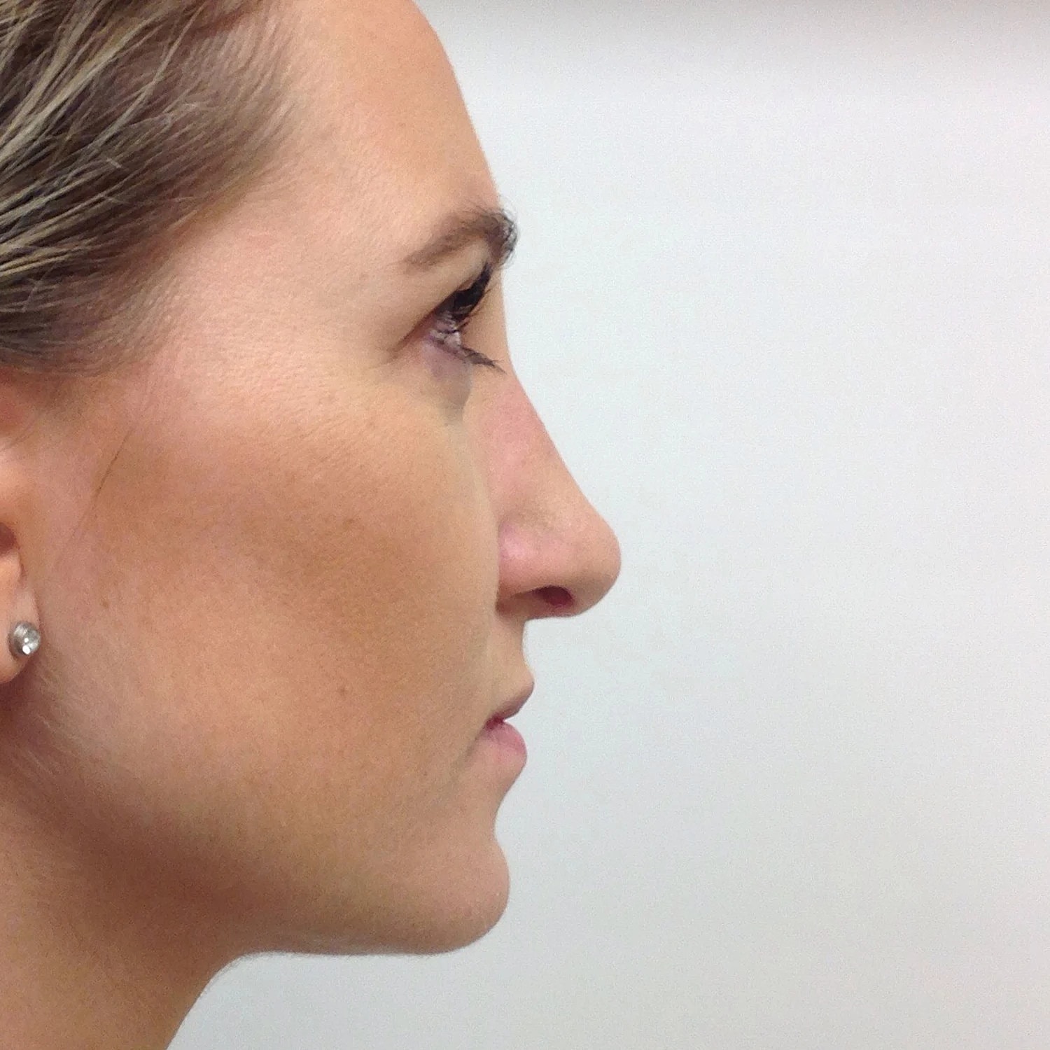 Rhinoplasty Before & After