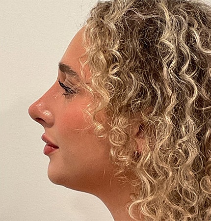 Rhinoplasty Before & After