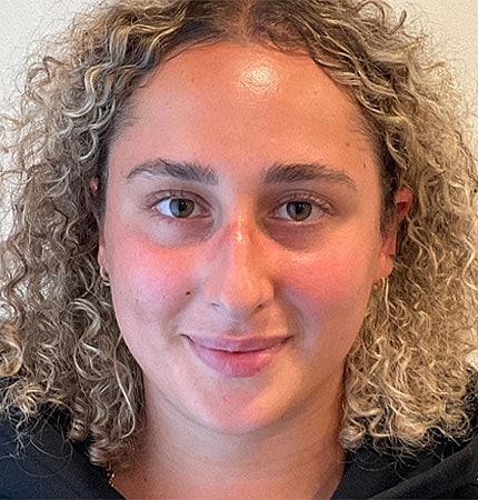 Rhinoplasty Before & After