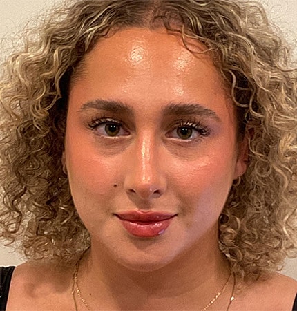 Rhinoplasty Before & After