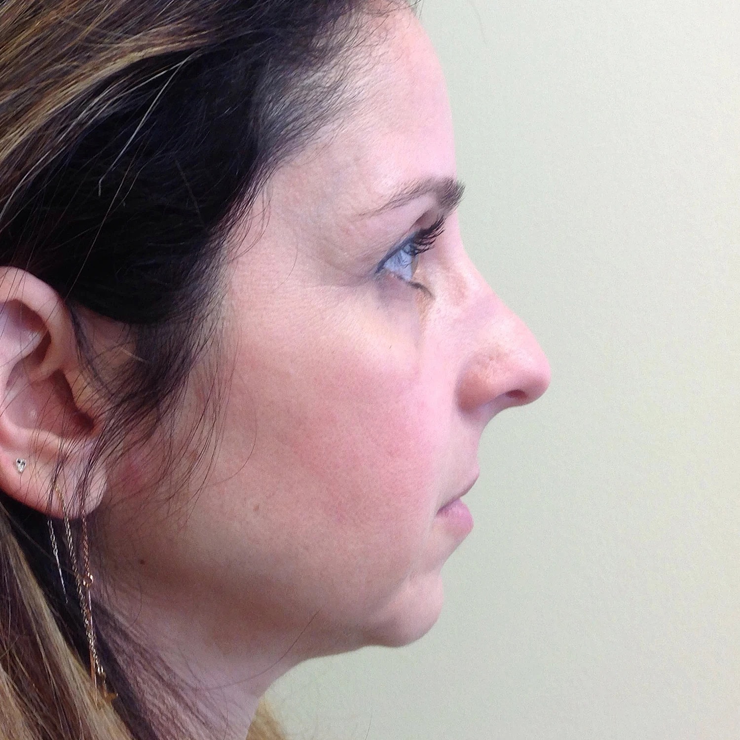 Rhinoplasty Before & After