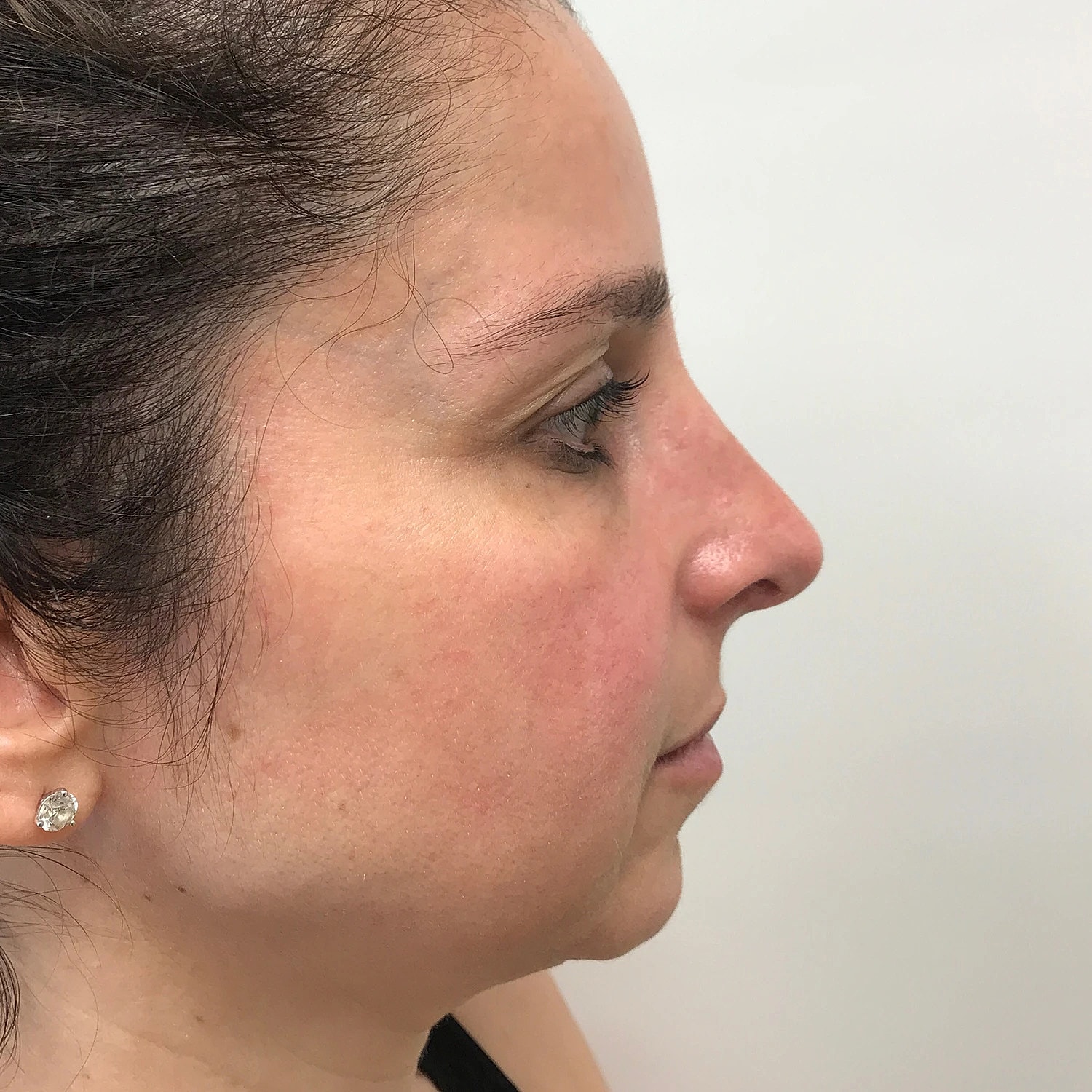Rhinoplasty Before & After